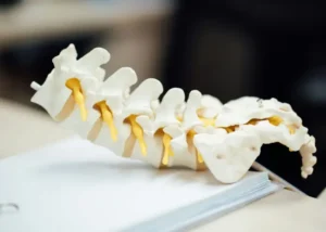 Lumbar spine model showing vertebrae and spinal nerves commonly involved in sciatica.