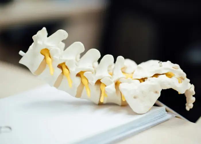 Lumbar spine model showing vertebrae and spinal nerves commonly involved in sciatica.